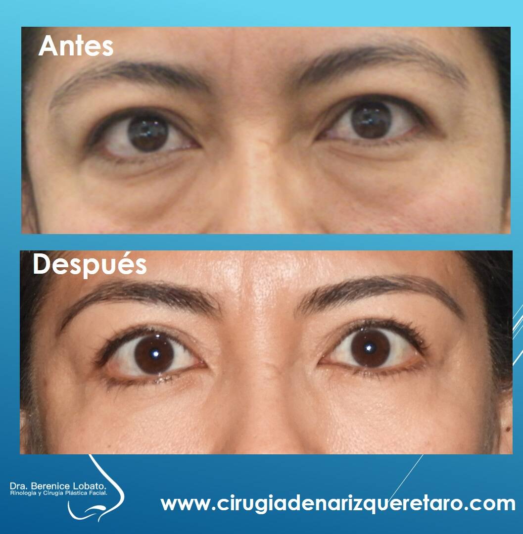  resultados de blefaroplastia o cirugia de perpados