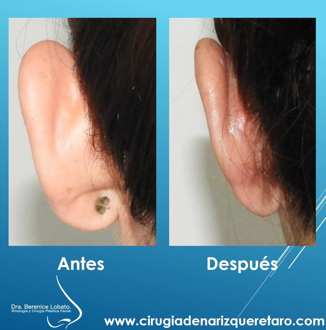 otoplastia en mujer resultados detras