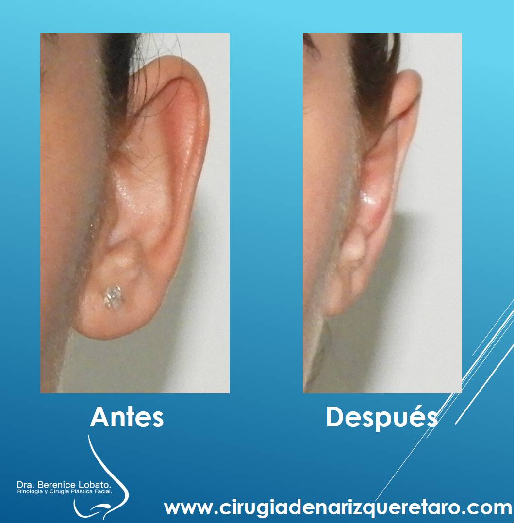 otoplastia en mujer resultados de frente