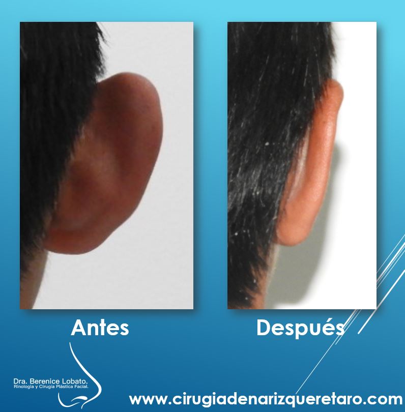 otoplastia en hombre resultados detras