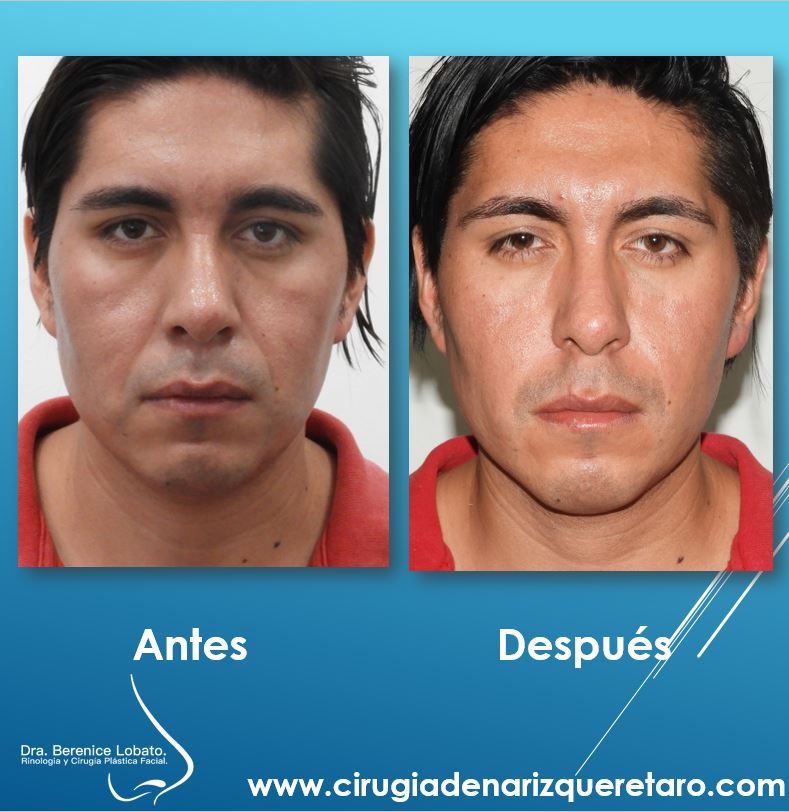 rellenos faciales en hombre resultados