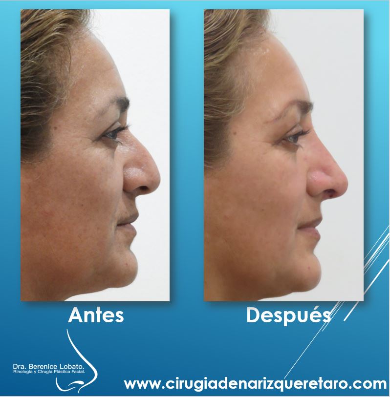 rinoplastia cirugia de nariz mujer perfil