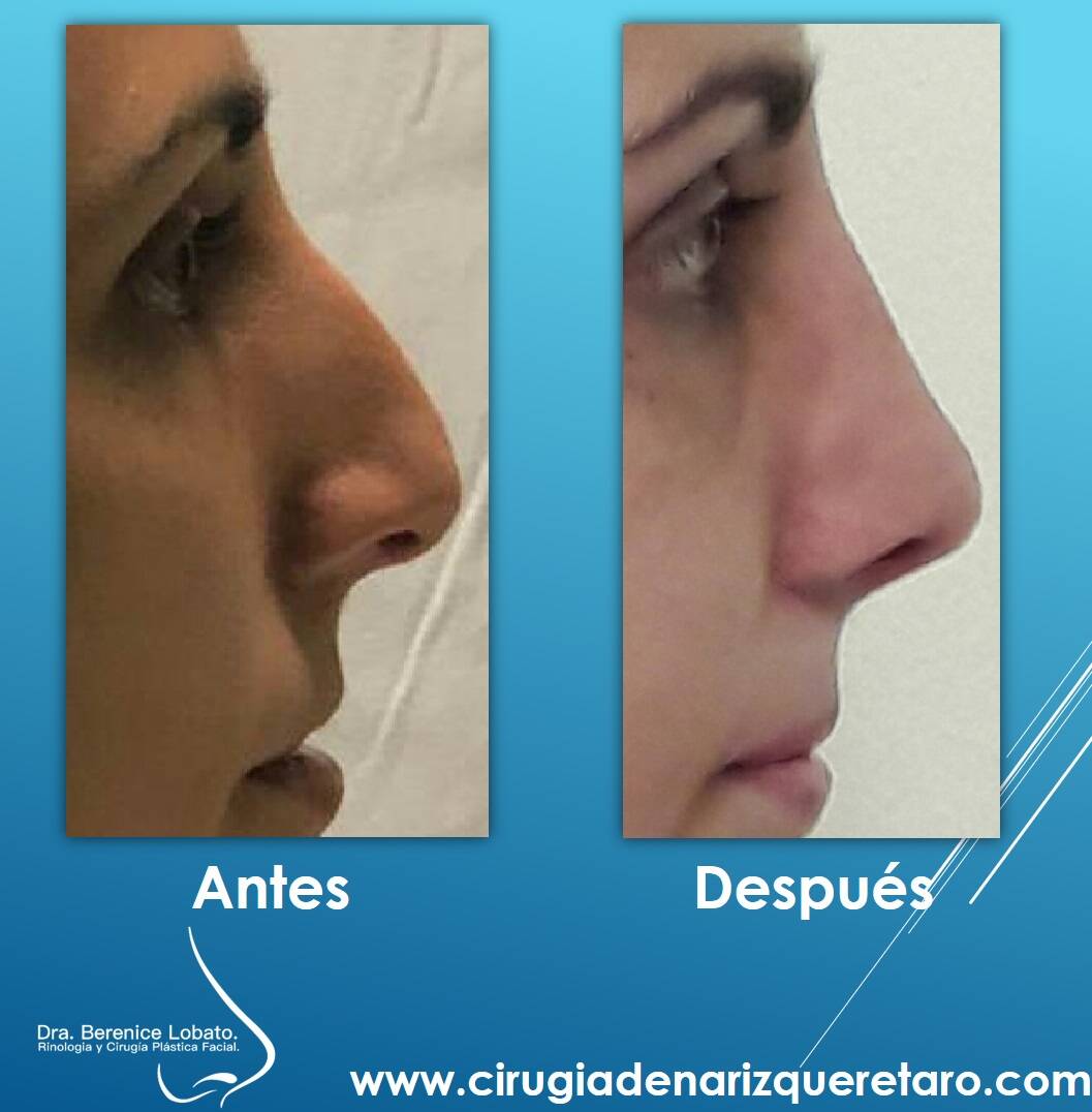 rinoplastia en mujer perfil resultados