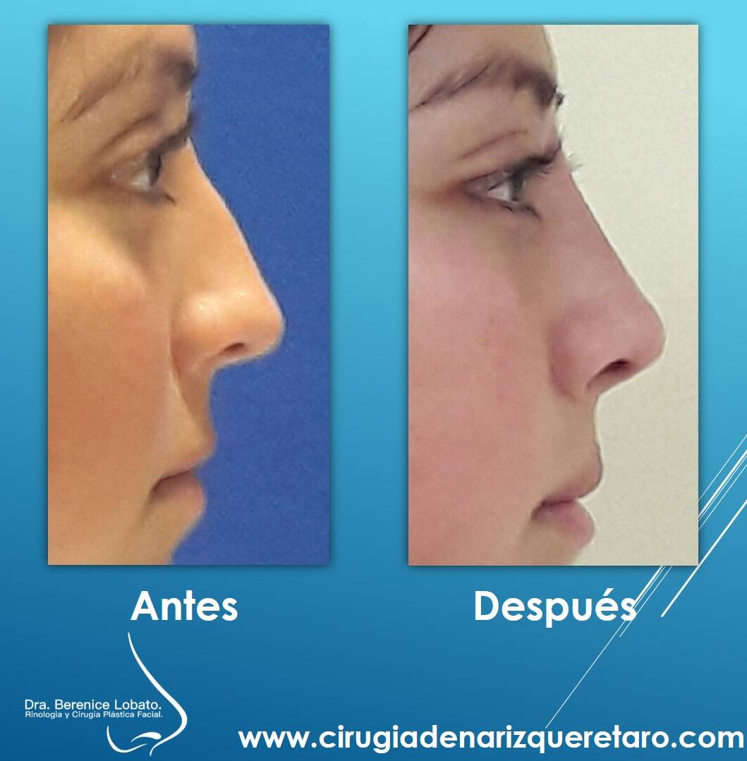 rinoplastia en mujer perfil resultados