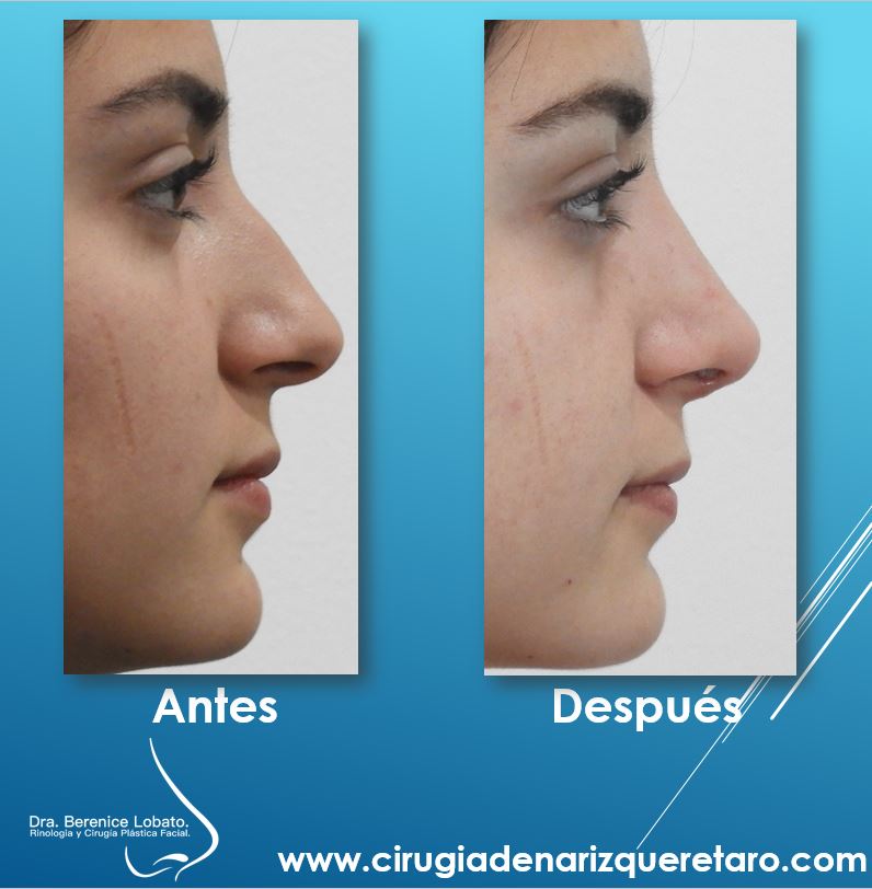 rinoplastia mujer perfil resultados