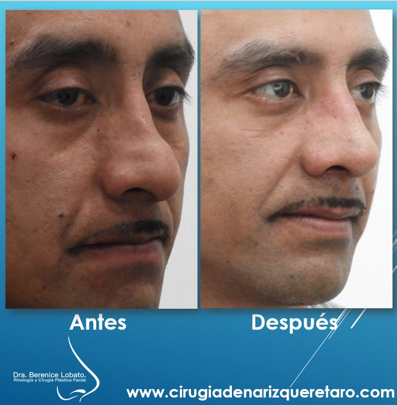  rinoplastia resultados nariz torcida