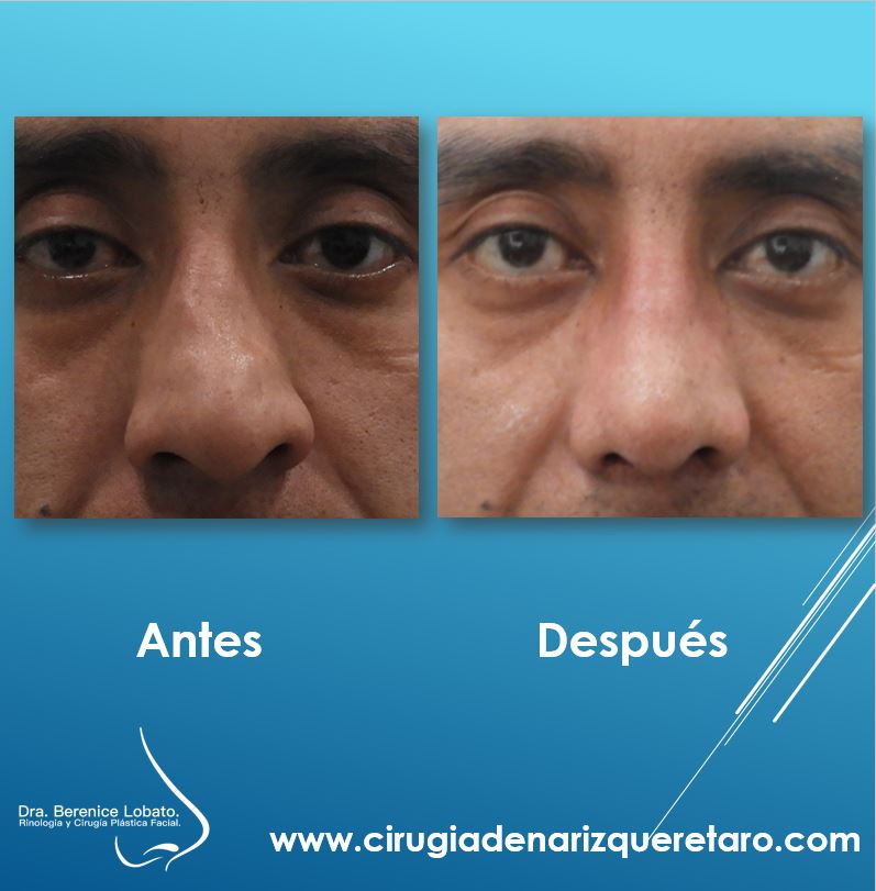  rinoplastia resultados nariz torcida